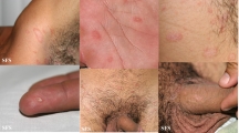 pityriasis rosea