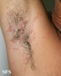 pityriasis rosea