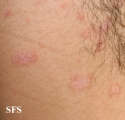 pityriasis rosea
