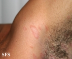 pityriasis rosea