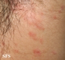 pityriasis rosea