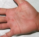 pityriasis rosea