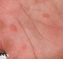 pityriasis rosea