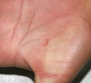 pityriasis rosea