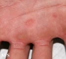 pityriasis rosea