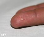 pityriasis rosea