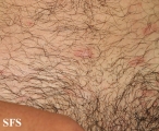 pityriasis rosea