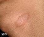 pityriasis rosea