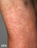 pityriasis rosea