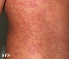 pityriasis rosea