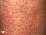pityriasis rosea