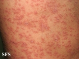 pityriasis rosea