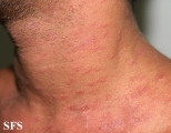 pityriasis rosea
