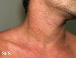 pityriasis rosea