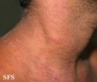 pityriasis rosea