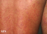 pityriasis rosea