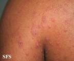 pityriasis rosea