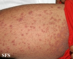 pityriasis rosea