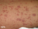pityriasis rosea