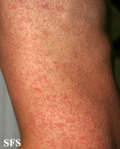 pityriasis rosea