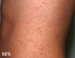 pityriasis rosea