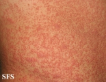 pityriasis rosea