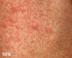pityriasis rosea