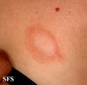pityriasis rosea