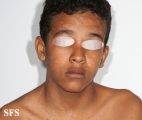pityriasis rosea