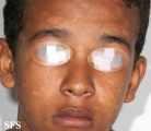 pityriasis rosea