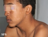 pityriasis rosea