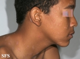 pityriasis rosea