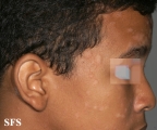 pityriasis rosea