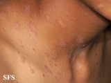 pityriasis rosea
