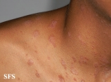 pityriasis rosea