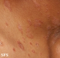 pityriasis rosea