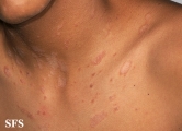 pityriasis rosea
