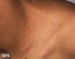 pityriasis rosea