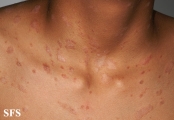 pityriasis rosea