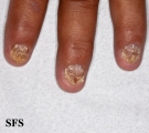 psoriasis- nail psoriasis