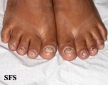 psoriasis- nail psoriasis