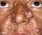 nevoid basal cell carcinoma syndrome