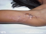 calcinosis circumscripta-idiopathic