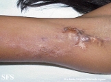 calcinosis circumscripta-idiopathic