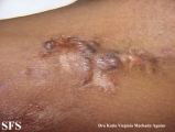 calcinosis circumscripta-idiopathic