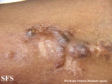calcinosis circumscripta-idiopathic