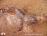 calcinosis circumscripta-idiopathic