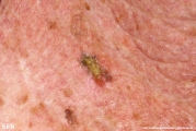 cutaneos horn