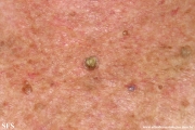 cutaneos horn