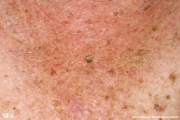 cutaneos horn